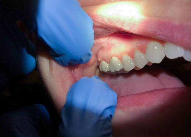 Best Emergency Broken Tooth Repair in Berryville, VA